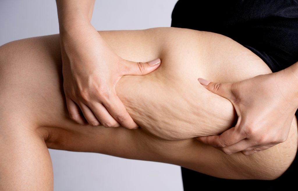 Combattez efficacement la cellulite : Quel sport choisir ?