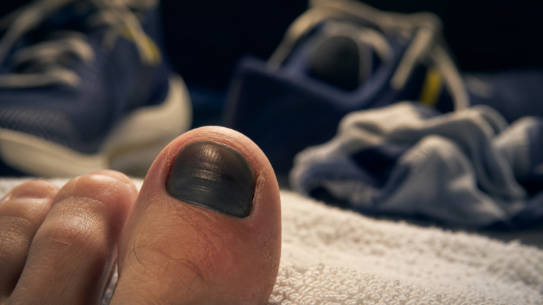 Orteil noir, ongle douloureux : hématome, mycose ou mélanome ? Orteil noir ongle : gros plan hématome douloureux